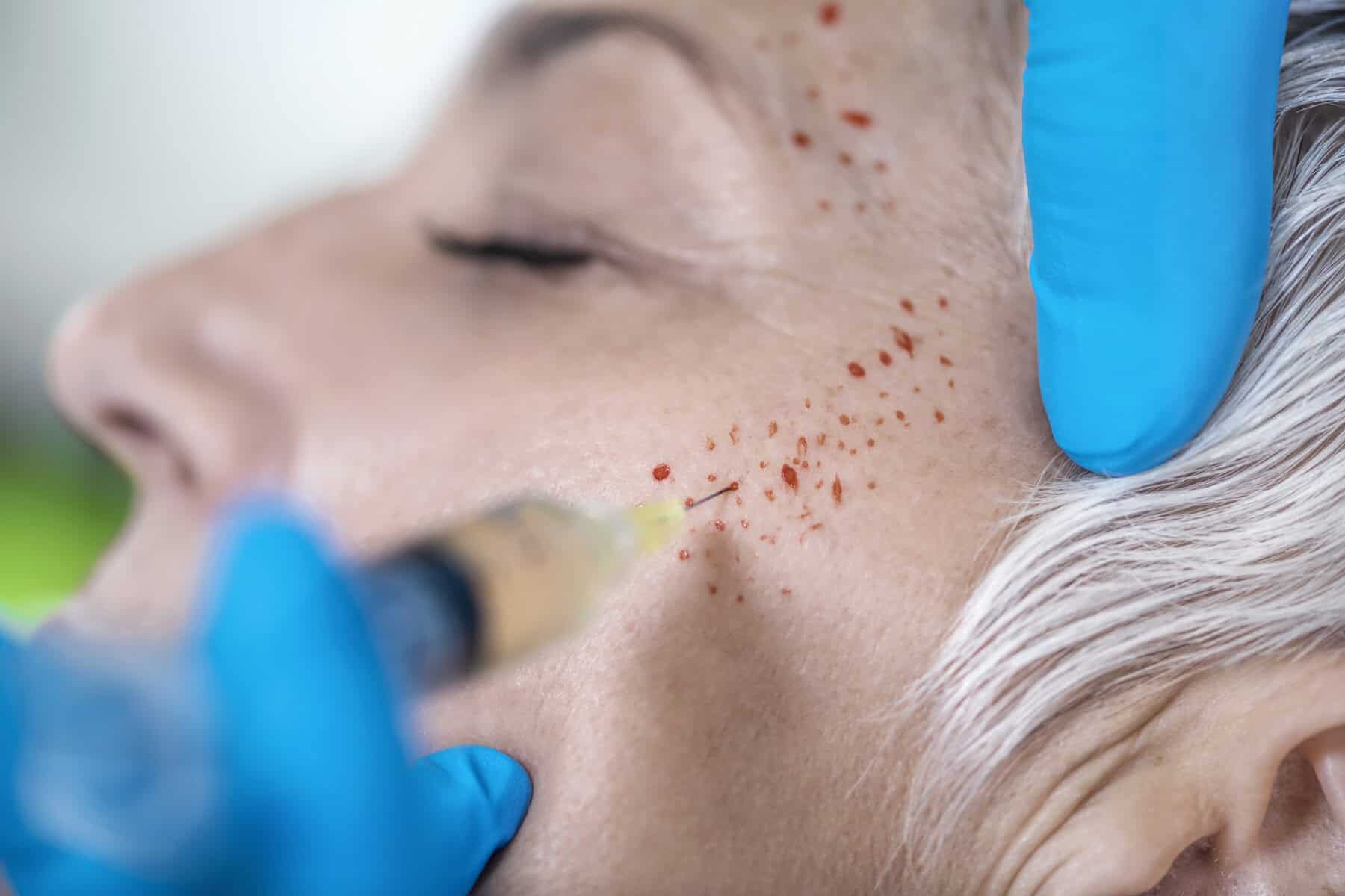 Microneedling or skin treatment performed on an elderly woman’s face with a medical device.